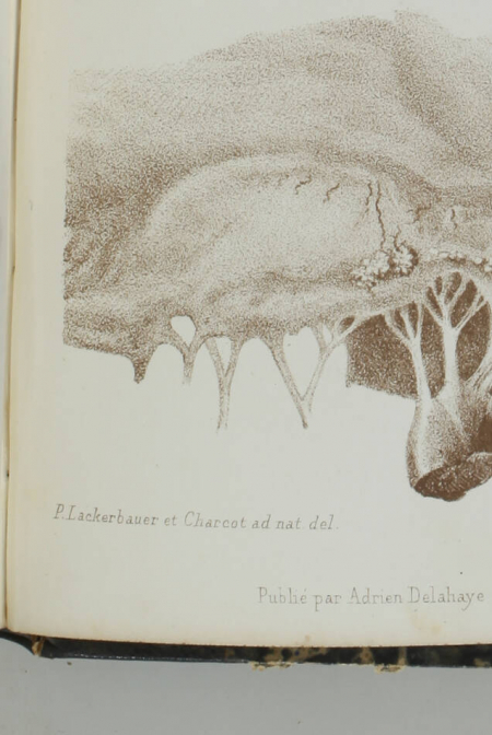 BARING GARROD - La goutte - 1867 - 8 planches couleurs - Notes de Charcot - Photo 3, livre rare du XIXe siècle